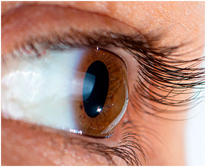 Foto sobre Ceratocone e Transplante de Cornea