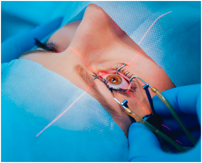 Foto sobre a cirurgia de catarata