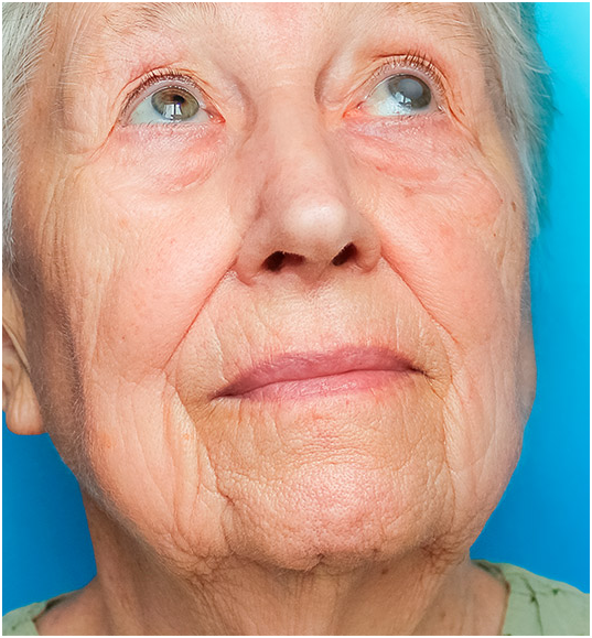 Foto Sobre a cirurgia de Catarata